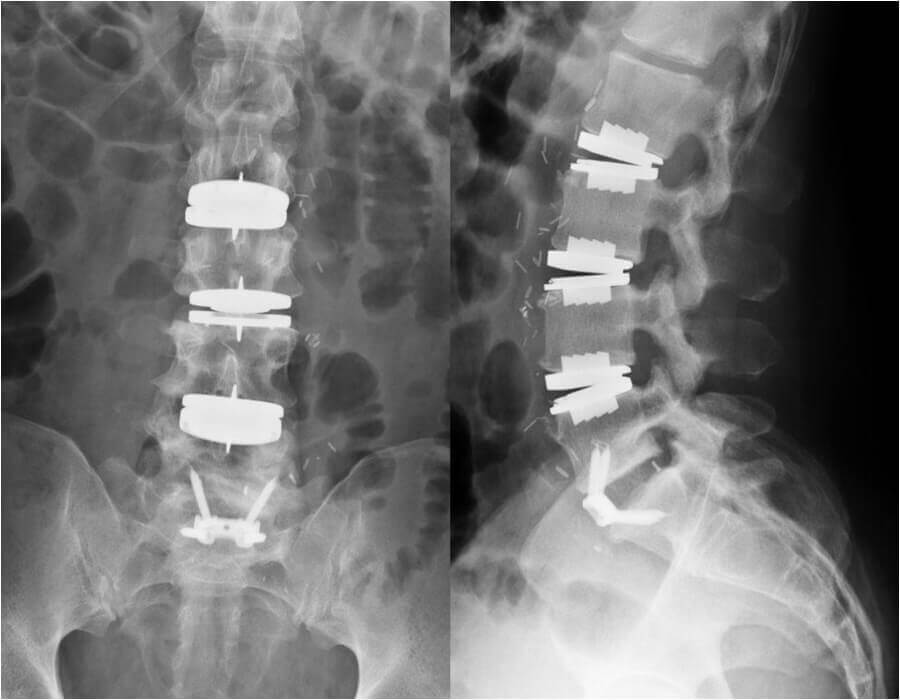 https://mkspinesurgery.com/wp-content/uploads/2019/05/mkropf-xray-on-focus.jpg