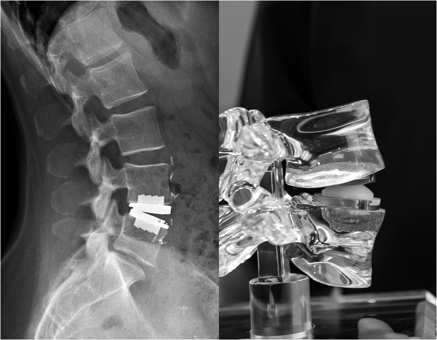 Lumbar Disc Replacement Surgery Recovery Doctorvisit