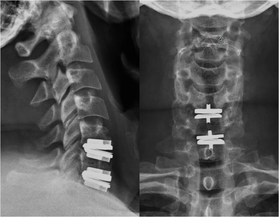 Anterior Cervical Disc Replacement X-Ray Image Dr Kropf Spine Surgeon